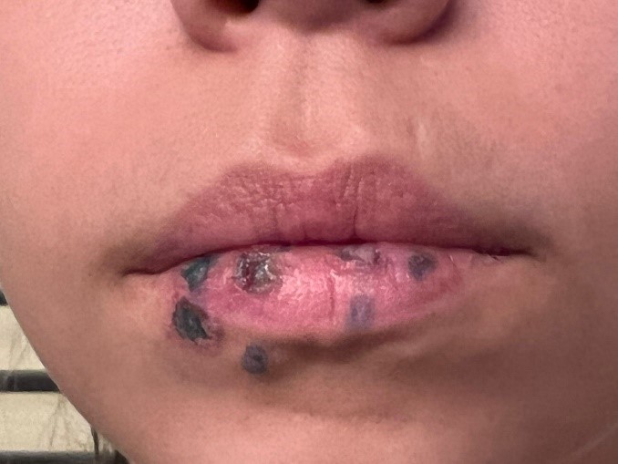 Lesão bucal causada pelo cigarro elerônico