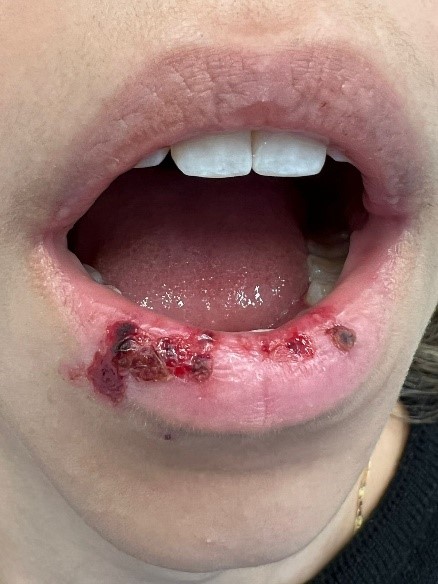 Lesão bucal causada pelo cigarro elerônico