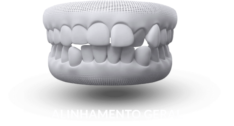 invisalign-alinhamento.png