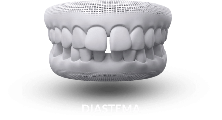 invisalign-diastema.png