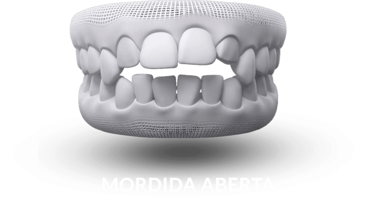 invisalign-mordida-aberta.png