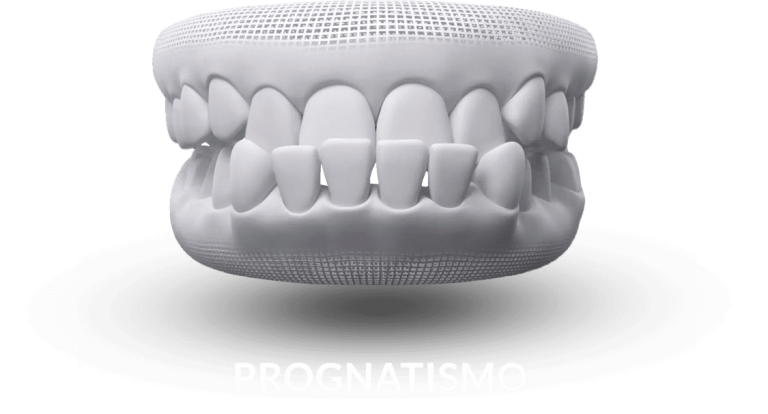 invisalign-prognatismo.png