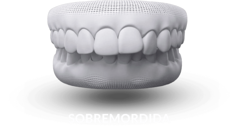 invisalign-sobremordida.png
