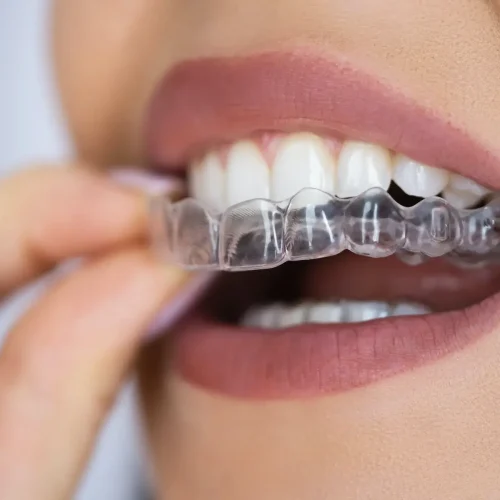 654b17f4a2fcfc932ebf32e7_sorriso-perfeito-invisalign-1200x1200-1.webp