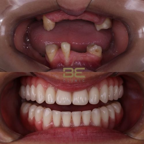 Implante_ Reabilitação